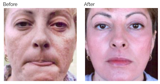 Before and After | Nonsurgical Facelifts - Victor Liu, MD