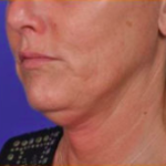 Facial Rejuvenation Before & After Patient #84