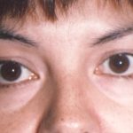 Eyelid and Brow Lift Before & After Patient #926