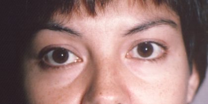 Eyelid and Brow Lift Before & After Patient #926