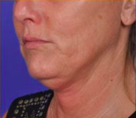 Facial Rejuvenation Before & After Patient #84