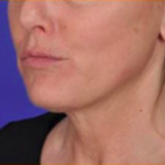 Facial Rejuvenation Before & After Patient #84