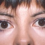Eyelid and Brow Lift Before & After Patient #926