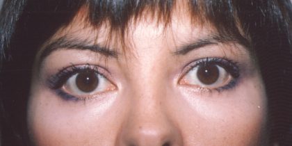 Eyelid and Brow Lift Before & After Patient #926