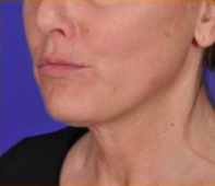 Facial Rejuvenation Before & After Patient #84