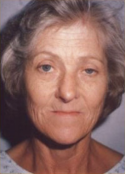 Facial Rejuvenation Before & After Patient #121