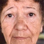 Non-Surgical Facelifts Before & After Patient #810