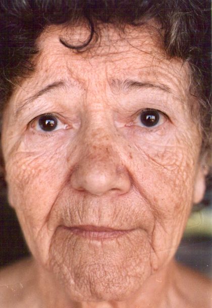 Non-Surgical Facelifts Before & After Patient #810