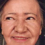 Non-Surgical Facelifts Before & After Patient #810