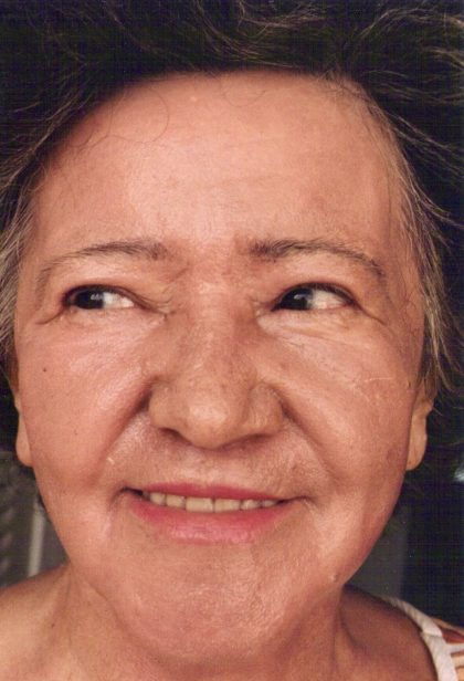 Non-Surgical Facelifts Before & After Patient #810