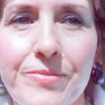 Non-Surgical Facelifts Before & After Patient #804