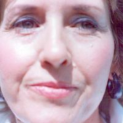 Non-Surgical Facelifts Before & After Patient #804