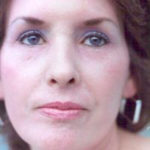 Non-Surgical Facelifts Before & After Patient #804