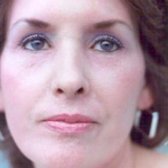 Non-Surgical Facelifts Before & After Patient #804