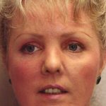 Non-Surgical Facelifts Before & After Patient #129