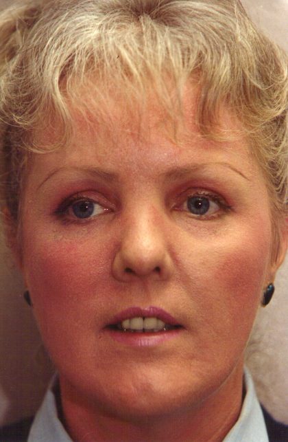 Non-Surgical Facelifts Before & After Patient #129