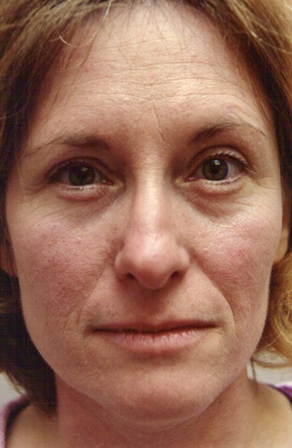 Facial Rejuvenation Before & After Patient #120