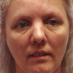 Non-Surgical Facelifts Before & After Patient #129