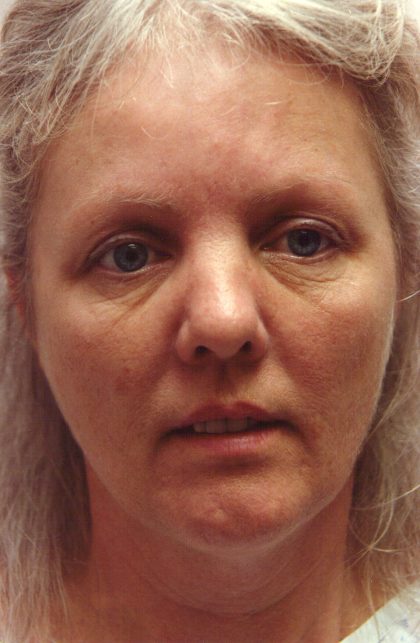 Non-Surgical Facelifts Before & After Patient #129