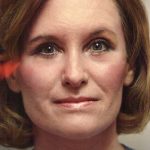 Facial Rejuvenation Before & After Patient #120