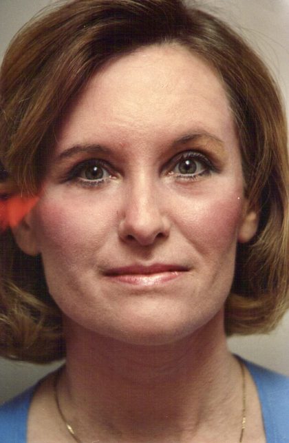 Facial Rejuvenation Before & After Patient #120