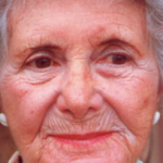 Non-Surgical Facelifts Before & After Patient #835