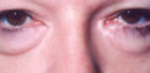 Lower Eyelids Before & After Patient #963