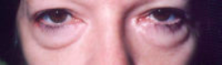 Lower Eyelids Before & After Patient #963