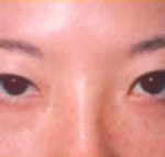 Asian Eyes Before & After Patient #1001