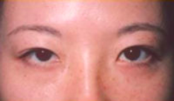 Asian Eyes Before & After Patient #1001