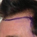 Hair Restoration & Reconstruction Before & After Patient #1045
