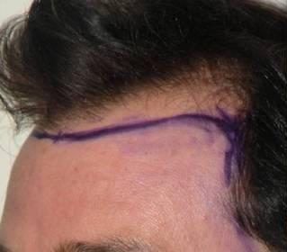 Hair Restoration & Reconstruction Before & After Patient #1045
