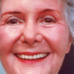 Non-Surgical Facelifts Before & After Patient #835