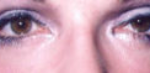Lower Eyelids Before & After Patient #963