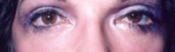 Lower Eyelids Before & After Patient #963