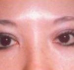 Asian Eyes Before & After Patient #1001