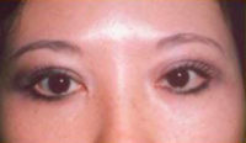 Asian Eyes Before & After Patient #1001