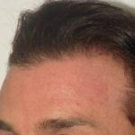 Hair Restoration & Reconstruction Before & After Patient #1045