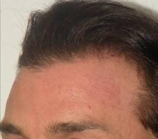 Hair Restoration & Reconstruction Before & After Patient #1045