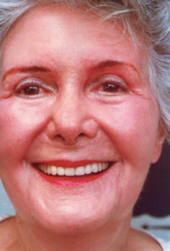 Non-Surgical Facelifts Before & After Patient #835