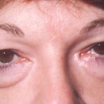 Eyelid and Brow Lift Before & After Patient #925