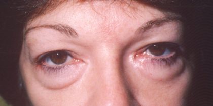 Eyelid and Brow Lift Before & After Patient #925