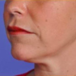 Facial Rejuvenation Before & After Patient #83