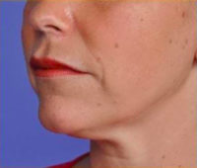Facial Rejuvenation Before & After Patient #83