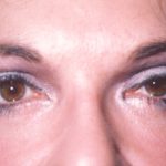Eyelid and Brow Lift Before & After Patient #925