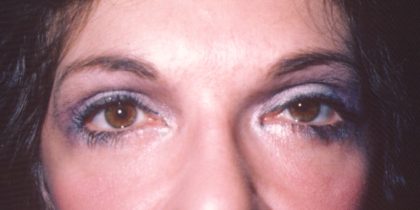 Eyelid and Brow Lift Before & After Patient #925