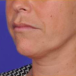 Facial Rejuvenation Before & After Patient #83