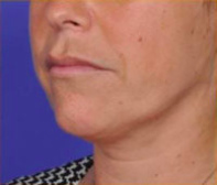 Facial Rejuvenation Before & After Patient #83