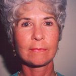 Facial Rejuvenation Before & After Patient #113