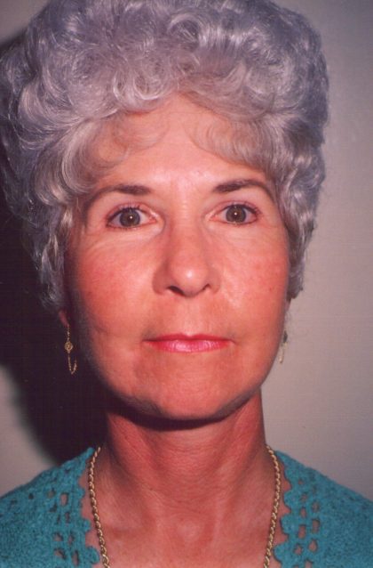Facial Rejuvenation Before & After Patient #113